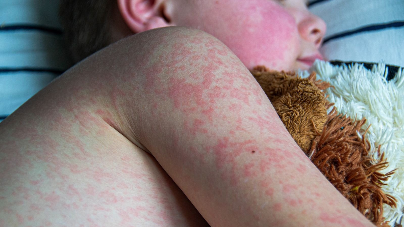 Measles rash on a child